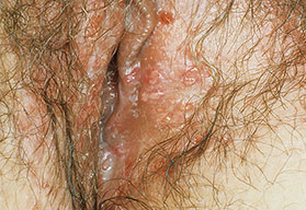 female-genital-herpes6