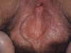 female-genital-herpes1