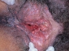 female-genital-herpes2