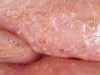 female-genital-herpes3