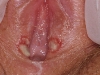 female-genital-herpes4