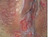 female-genital-herpes5