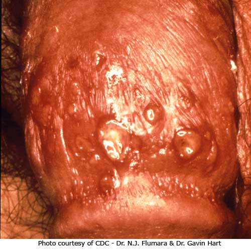 male-genital-herpes2