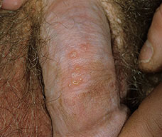 male-genital-herpes3