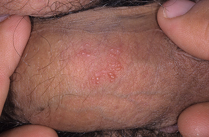 male-genital-herpes4