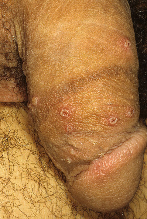 male-genital-herpes5