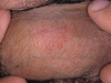 male-genital-herpes4