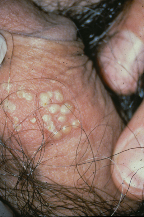 Pictures of Genital Herpes - Male.