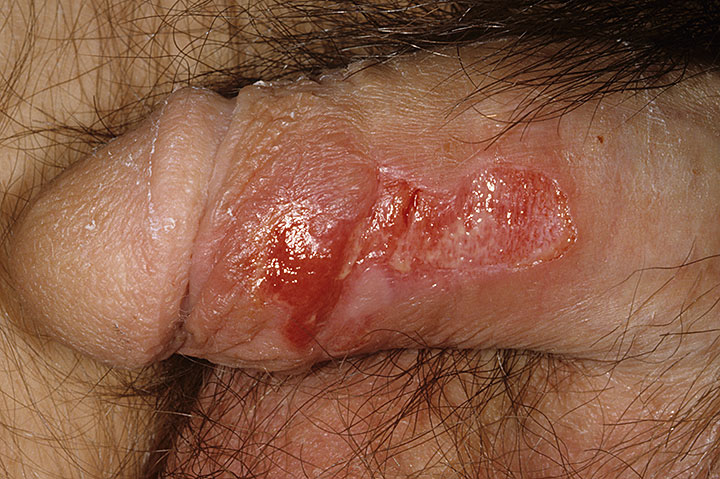 Pictures of Genital Herpes - Male.